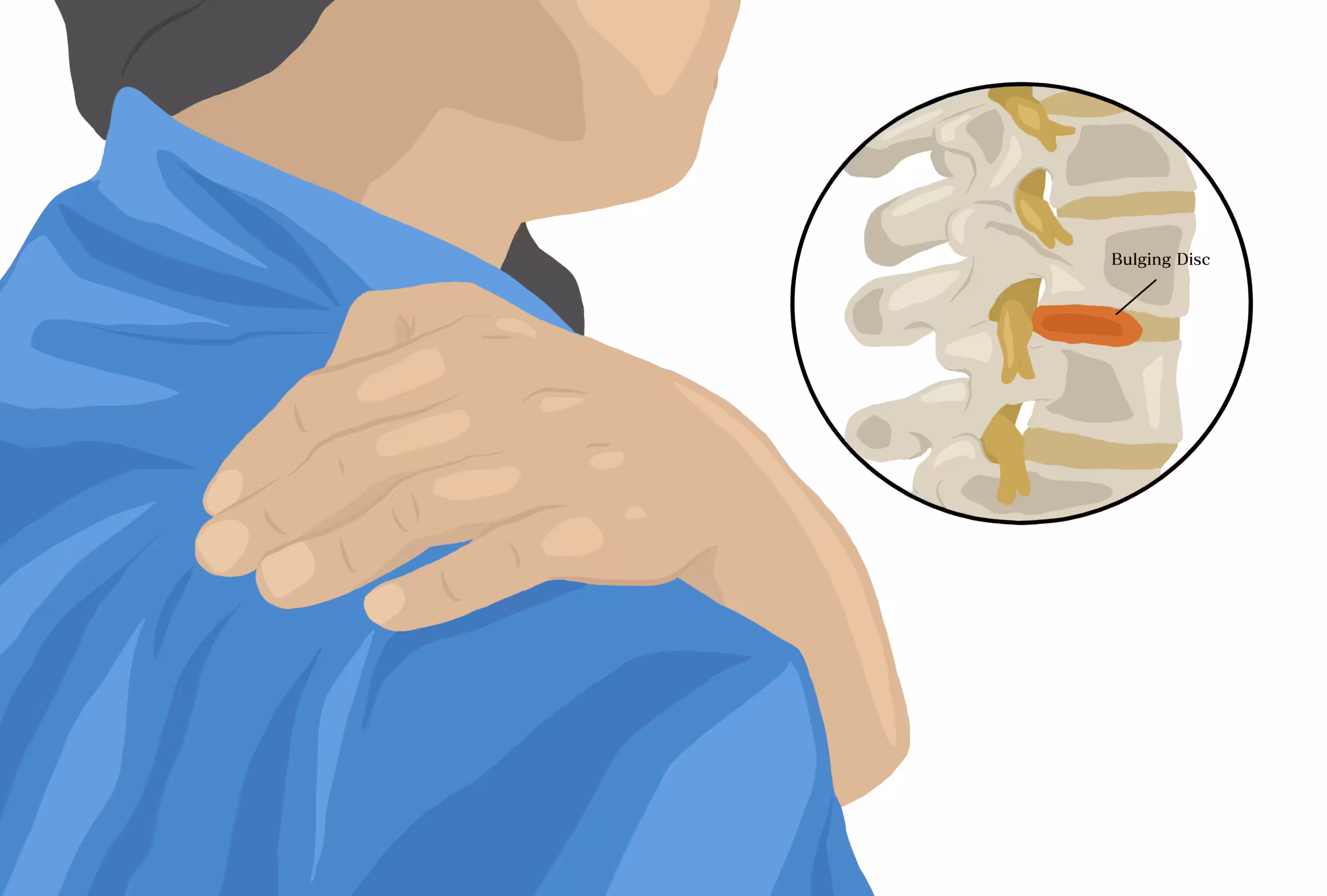 bulging disc pain after a car accident