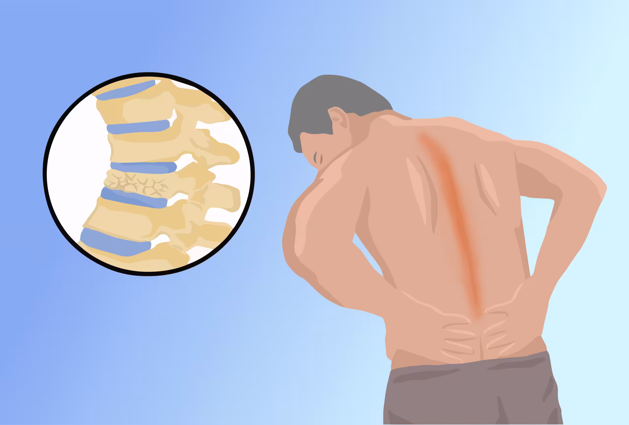 radiating pain in middle of back from a vertebral fracture