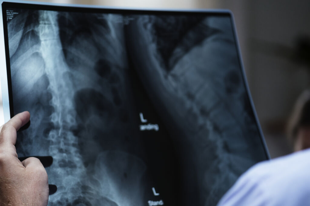 Can a Car Accident Cause Scoliosis?