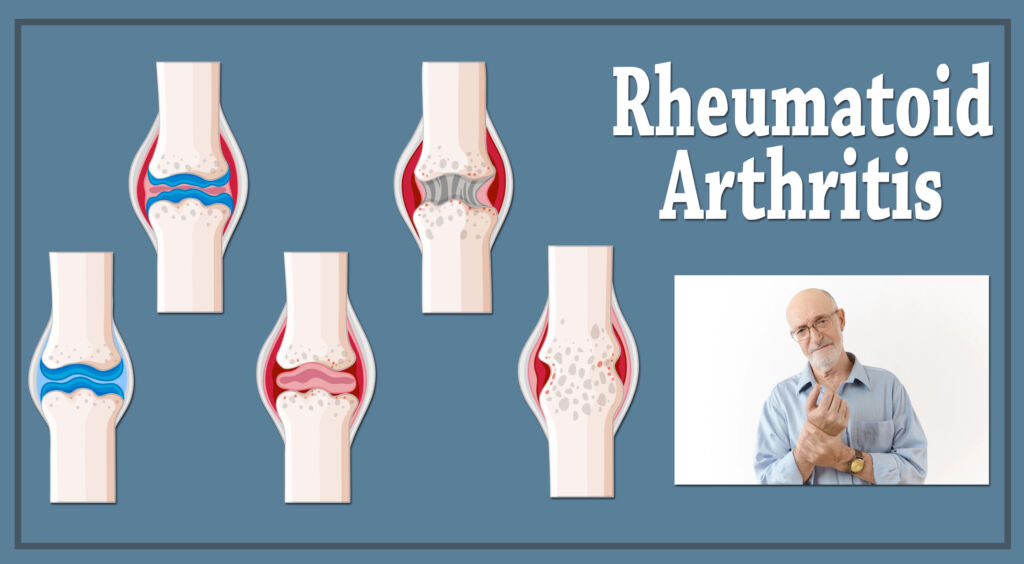 Can a Car Accident Cause Rheumatoid Arthritis?