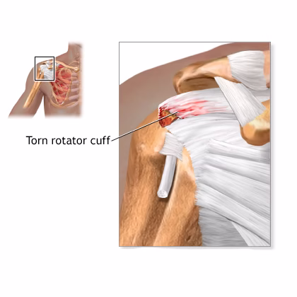Can a Car Accident Cause a Torn Rotator Cuff?