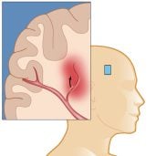 Symptoms of Internal Bleeding After a Car Accident 9 Internal Hemorrhaging From Car Accident