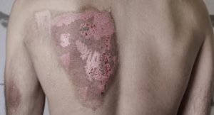 How Much is a Burn Injury Worth in Oklahoma City? 6 How Much is a Burn Injury Worth in Oklahoma City